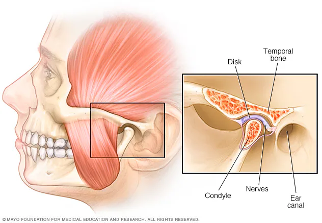 ds00355_im00012_mcdc7_tmj_jpg (1) Tmj Disorder Treatment