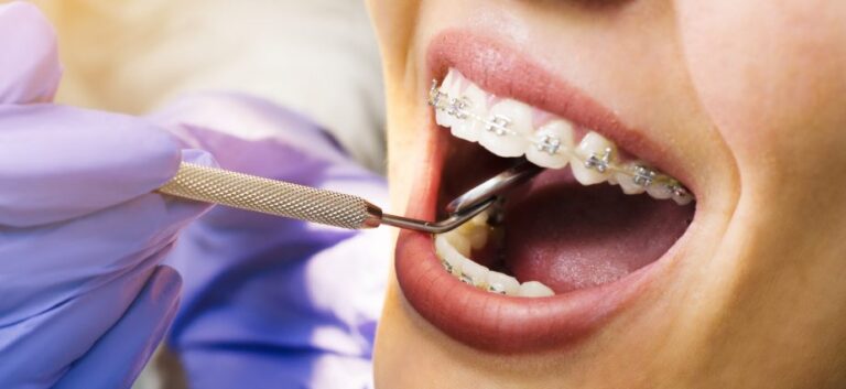 Why Tooth Removal Is Sometimes Required Before Braces and How the Process Works