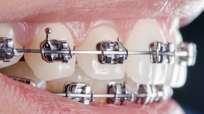8ab3be4133cb76 orthodontic